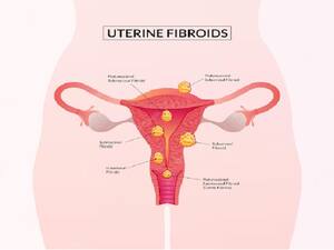 Working Women Have More Chances Of Getting Uterine Fibroids; Here’s How You Can Prevent It