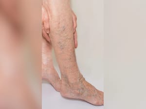 पैरों पर बैंगनी और नीली नसें दिखने का इलाज