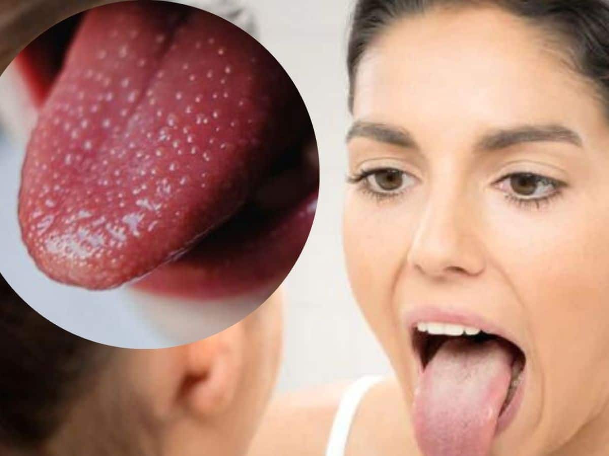 Vitamin B12 Deficiency Symptoms: 7 Unusual Signs That Can Appear In Your Mouth