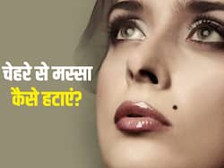 चेहरे पर मस्सा आपकी खूबसूरती को कर सकता है खराब, इन 5 नुस्खों से हटाएं ये दाग
