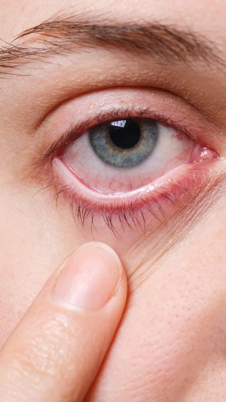 Can Omega-3-Fatty Acids Help Reduce Symptoms Of Pink Eye?