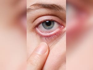 Can Omega-3-Fatty Acids Help Reduce Symptoms Of Pink Eye?