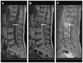 Spinal Tuberculosis Is Curable: Timely Detection And Medical Treatment