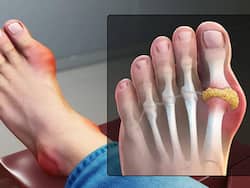 Uric Acid Home Remedies: 7 Ways To Lower Uric Acid Levels Naturally