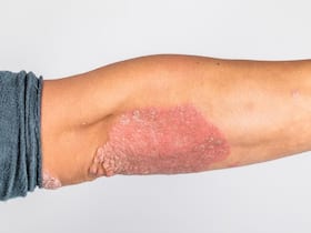 Unveiling The Power of Homeopathy: Effective Management of Skin Conditions Without Side Effects Unveiling The Power of Homeopathy: Effective Management of Skin Conditions Without Side Effects