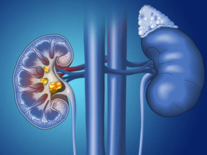 kidney stone hone par kya na khaye किडनी की पथरी होने पर भूलकर भी न