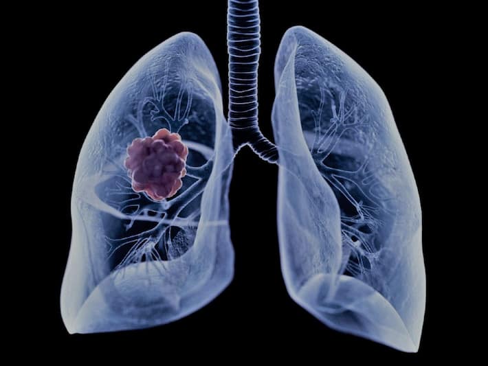 Lung Cancer Treatment: Traditional Approach Vs Multidisciplinary Care ...