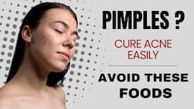 Avoid These Foods If You Have Acne !