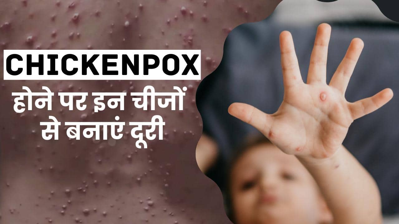 Chickenpox होने पर तुरंत करें इन चीजों से परहेज, जल्द मिलेगा आराम
