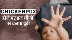 Chickenpox होने पर तुरंत करें इन चीजों से परहेज, जल्‍द म‍िलेगा आराम