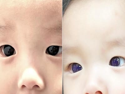 Baby's Dark-Brown Eyes Turn Blue After Covid-19 Treatment With Favipiravir: Here's Why