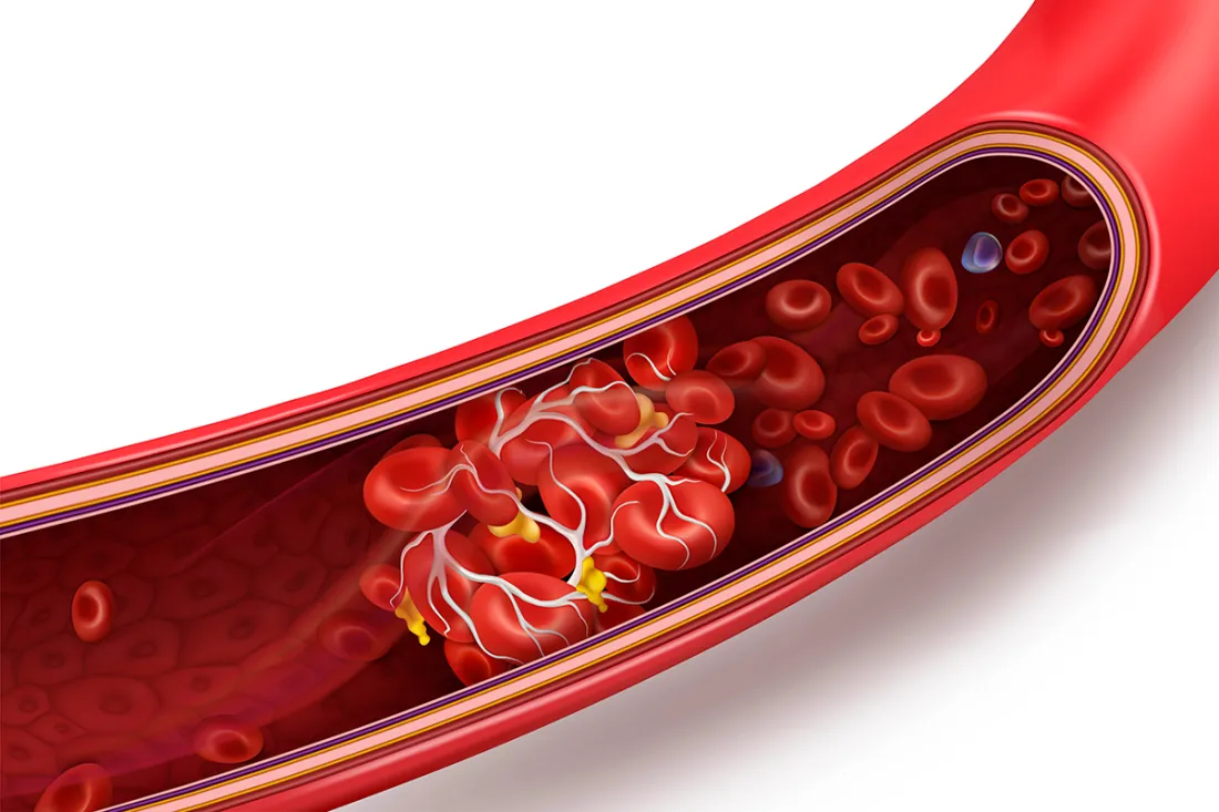 Recognizing Different Symptoms Of Heart Disease In Blood Vessels
