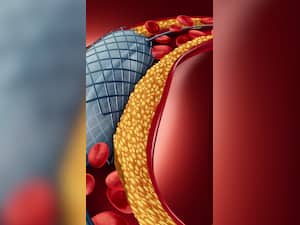 10 Powerful Yoga Asanas To Lower High Cholesterol Naturally