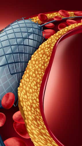 10 Powerful Yoga Asanas To Lower High Cholesterol Naturally