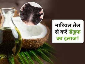 डैंड्रफ को जड़ से हटाने के लिए नारियल तेल में मिलाकर लगाएं ये 3 चीजें, बाल बनेंगे मजबूत और घने