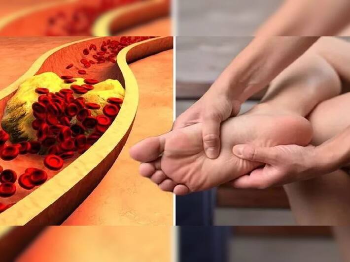 High Cholesterol Symptoms 5 High Cholesterol Signs To Look