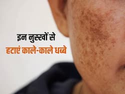 चेहरे पर काले-काले धब्बों से खूबसूरती हो सकती है खराब, इन आसान  से उपायों से करें इसका इलाज
