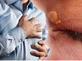 High Cholesterol Symptoms In Men: 7 Ayurvedic Herbs To Flush Out Bad Cholesterol From Your Body
