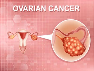 Exposure To Forever Chemicals May Up The Risk Of Ovarian Cancer, Says Study