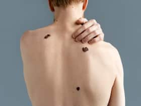 Men And Wealthy People More Likely To Develop Skin Cancer: Know Why