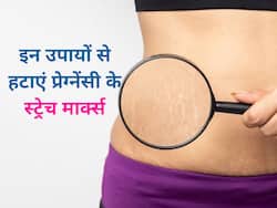 डिलीवरी के बाद स्ट्रेच मार्क्स से हैं परेशान? छुटकारा पाने के लिए आजमाएं ये 5 घरेलू उपाय
