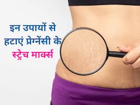 डिलीवरी के बाद स्ट्रेच मार्क्स से हैं परेशान? छुटकारा पाने के लिए आजमाएं ये 5 घरेलू उपाय