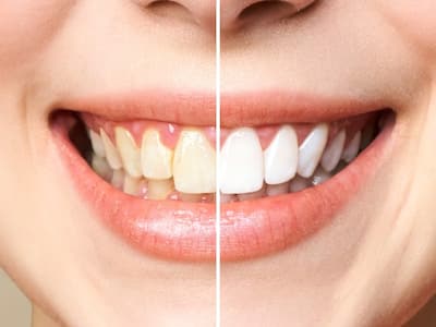 Teeth Whitening Is More Than Just A Cosmetic Enhancement: Expert Reveals Its Health Benefits