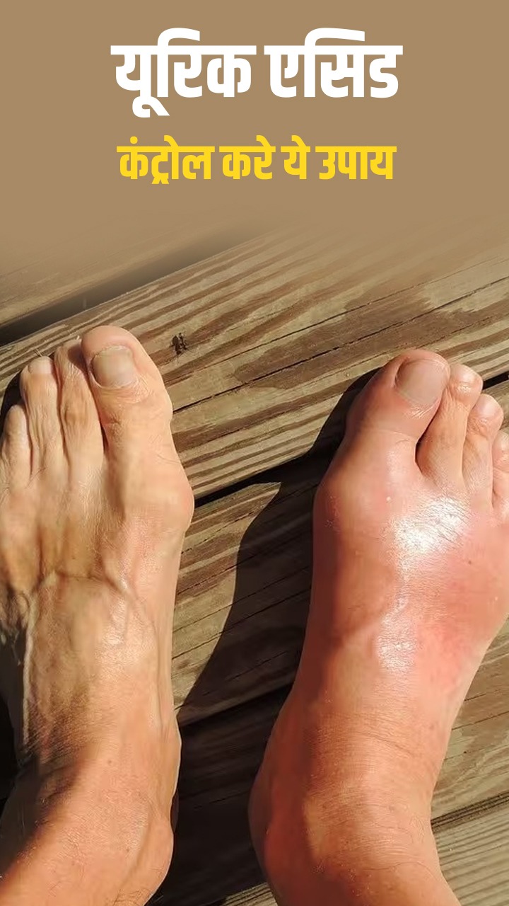 यूरिक एसिड कंट्रोल करने के आसान से उपाय