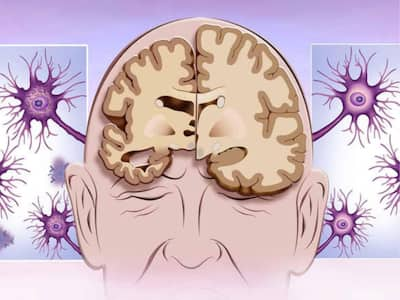 Vitamin E for Alzheimer's: Can It Slow the Progression of the Disease?