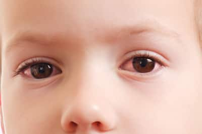 Airborne Infections: How Do You Protect Your Child From Conjunctivitis?