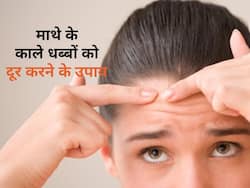माथे के काले धब्बों से है परेशान, तो इन उपाय से करें दूर