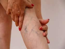 Get Rid Of Spider Veins With These Seven Natural Methods
