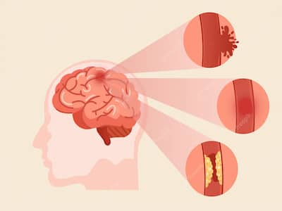 Brain Stroke: Can Timely Diagnosis Prevent Patients From Permanent Paralysis And Death?