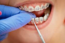 Orthodontics: How To Achieve A Beautiful Smile Without Tooth Extractions?