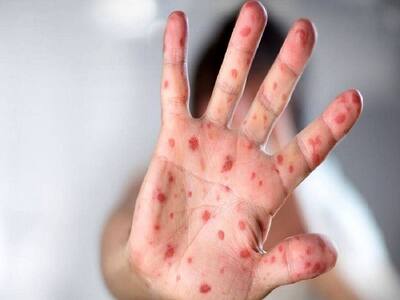 Hand, Foot And Mouth Disease Rising Sharply In Kolkata