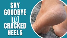 Say goodbye to cracked heels! Know prevention tips and home remedies to get smooth feet