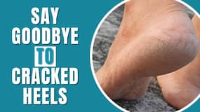Say goodbye to cracked heels! Know prevention tips and home remedies to get smooth feet