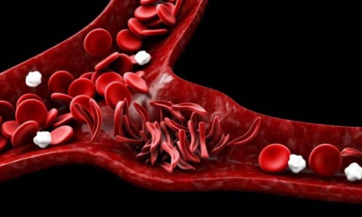 The Role Of Advanced Flow Cytometry In Multiple Hematological Disorders - Vimarsana News