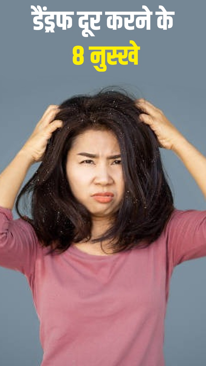 इन 8 असरदार नुस्खों से सर्दियों में डैंड्रफ की समस्या करें दूर