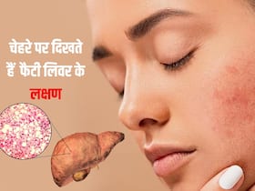 फैटी लिवर की समस्या होने पर चेहरे पर दिखते हैं ये 5 लक्षण, भूलकर भी न करें नजरंदाज फैटी लिवर की समस्या होने पर चेहरे पर दिखते हैं ये 5 लक्षण, भूलकर भी न करें नजरंदाज