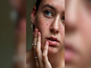 9 Eating Habits That Might Harm Your Skin