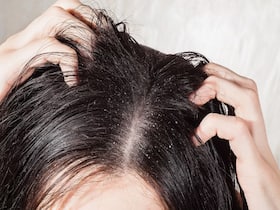 Sticky, Itchy Scalp Can Lead To Hair Loss: Causes And Remedies