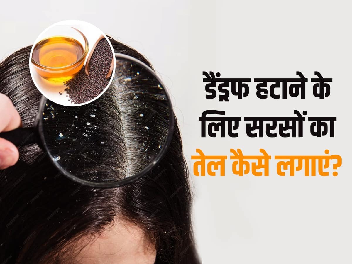 How To Use Mustard Oil For Dandruff In Hindi डैंड्रफ से छुटकारा दिला
