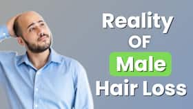 Hair Loss : Unveiling Male Hair Loss Trends in India Hair Loss : Unveiling Male Hair Loss Trends in India
