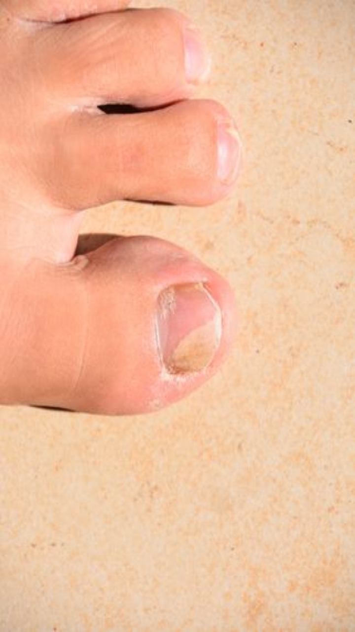 Top 10 Home Remedies to Combat Toenail Fungus