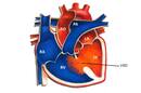 What Is Congenital Septal Defect In Babies And Its Causes?