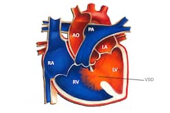 What Is Congenital Septal Defect In Babies And Its Causes?