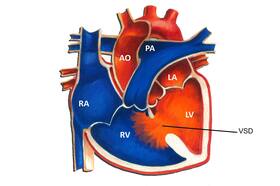 What Is Congenital Septal Defect In Babies And Its Causes?