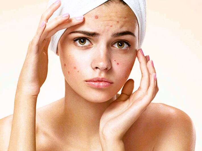 How To Use Rosemary Oil For Pimples?
