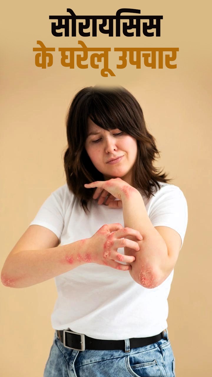 world psoriasis day: सोरायसिस से छुटकारा पाने के लिए अपनाएं ये 5 घरेलू उपाय